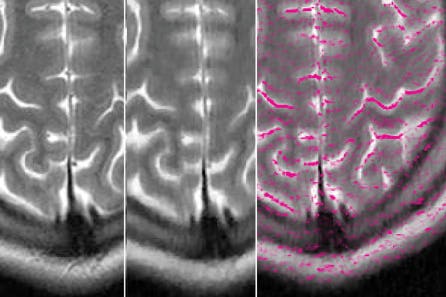 In a traditional MRI image (left), each pixel represents a type of tissue.